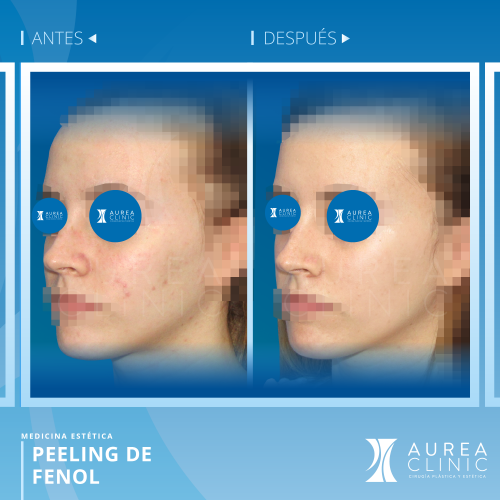 Peeling de Fenol